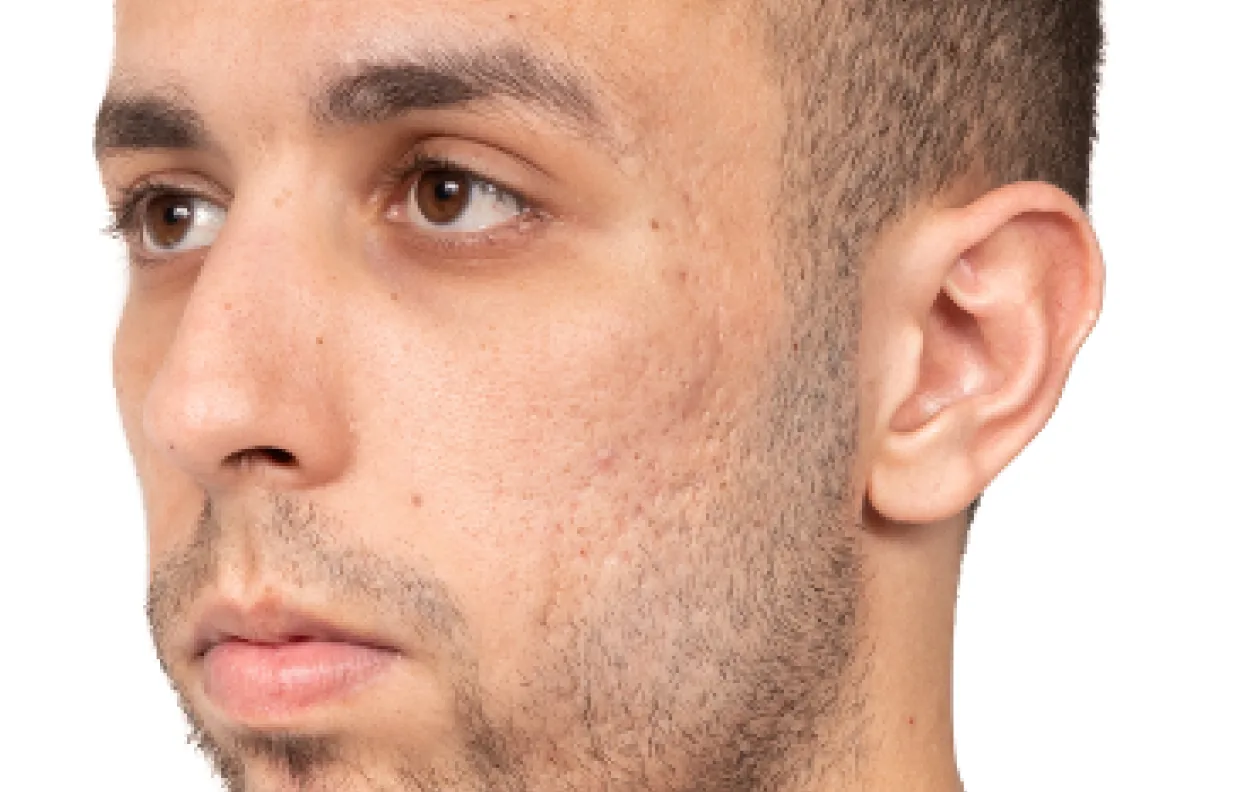 Skin 3 months after 2 treatments