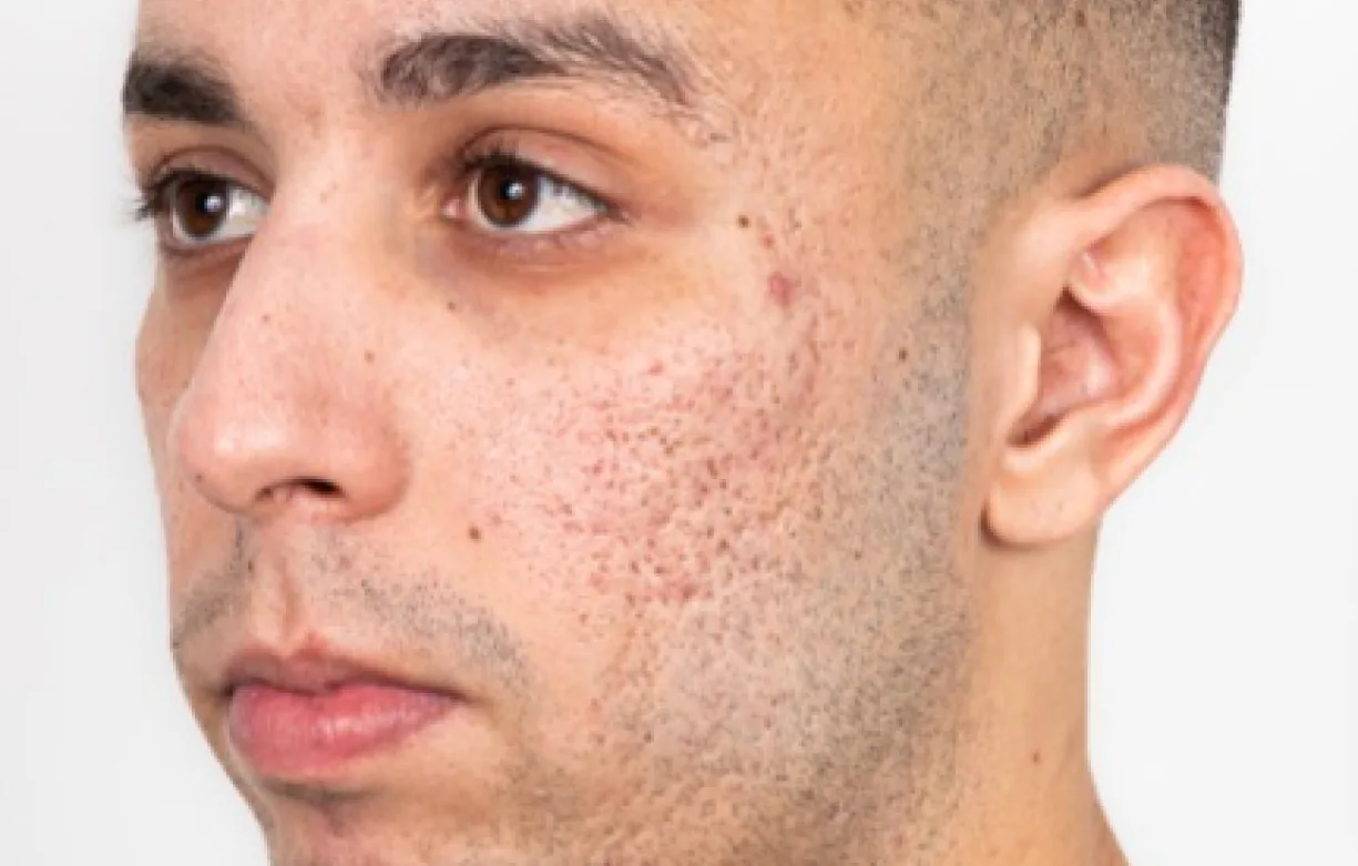 Skin with acne scars before treatment
