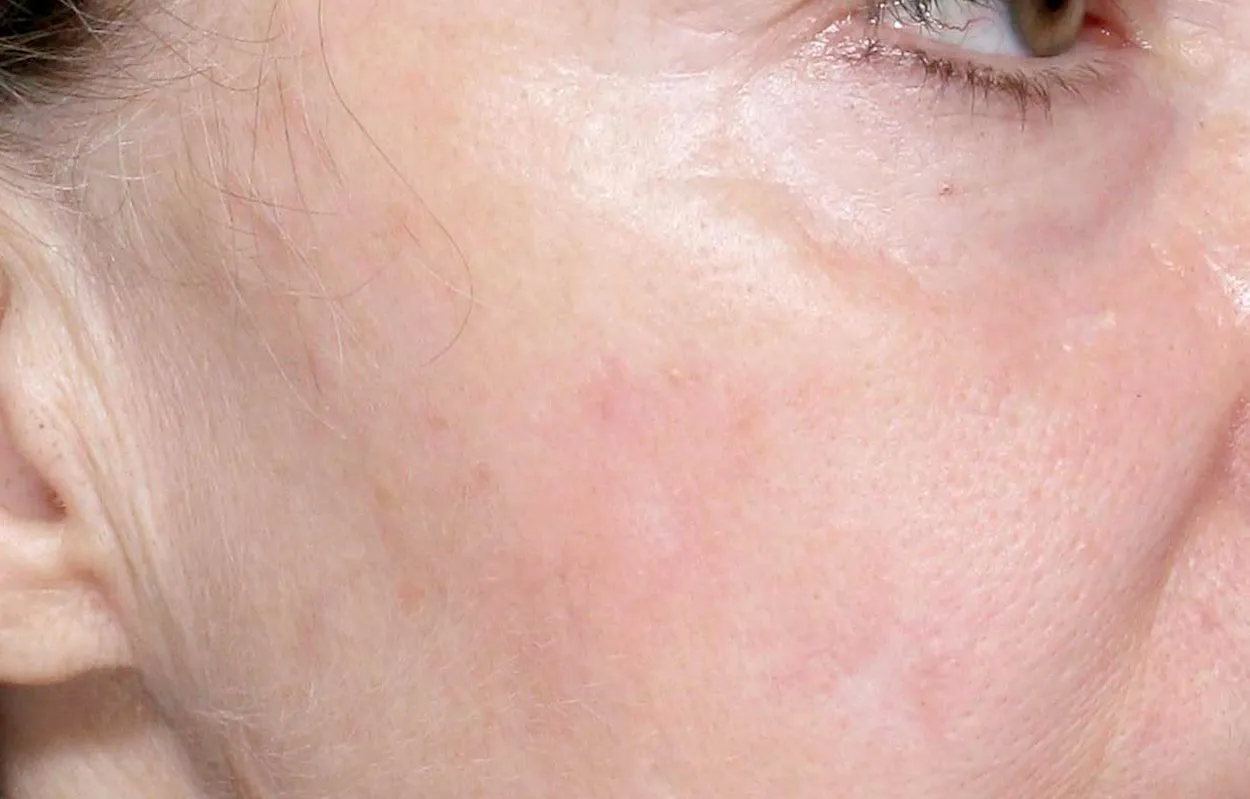 Skin 6 months after 5 treatments