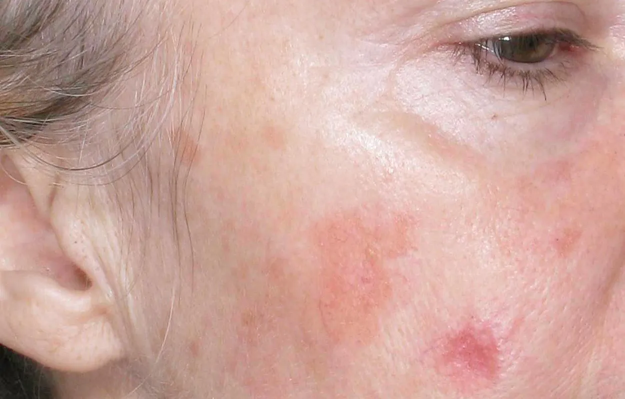 Skin with pigmented lesions before treatment