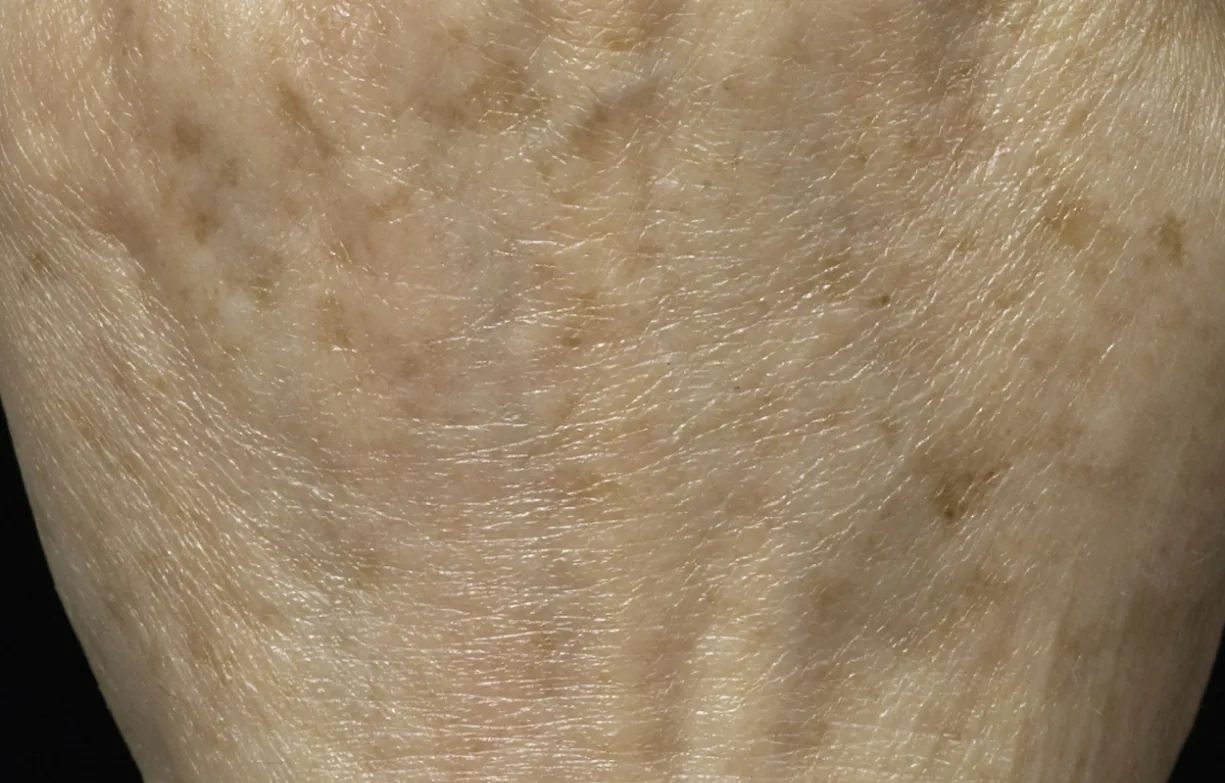 Skin after treatment