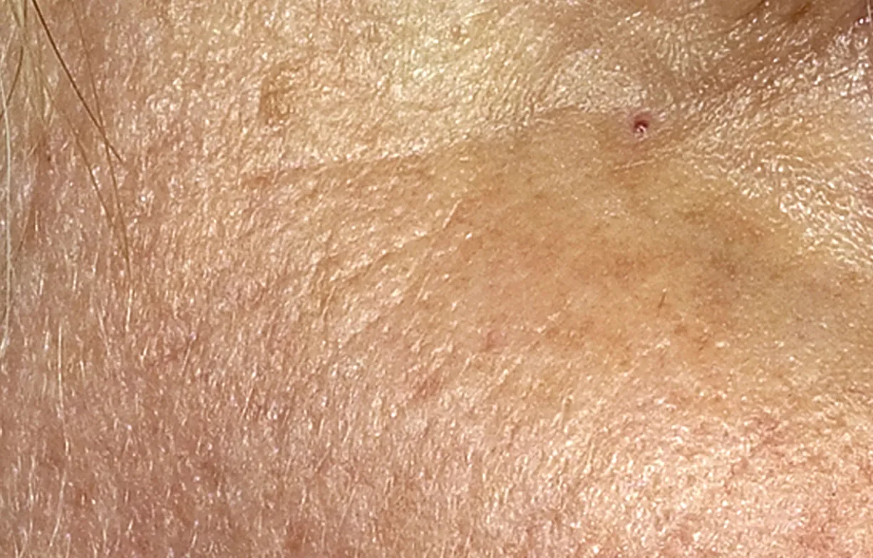 Skin after treatment