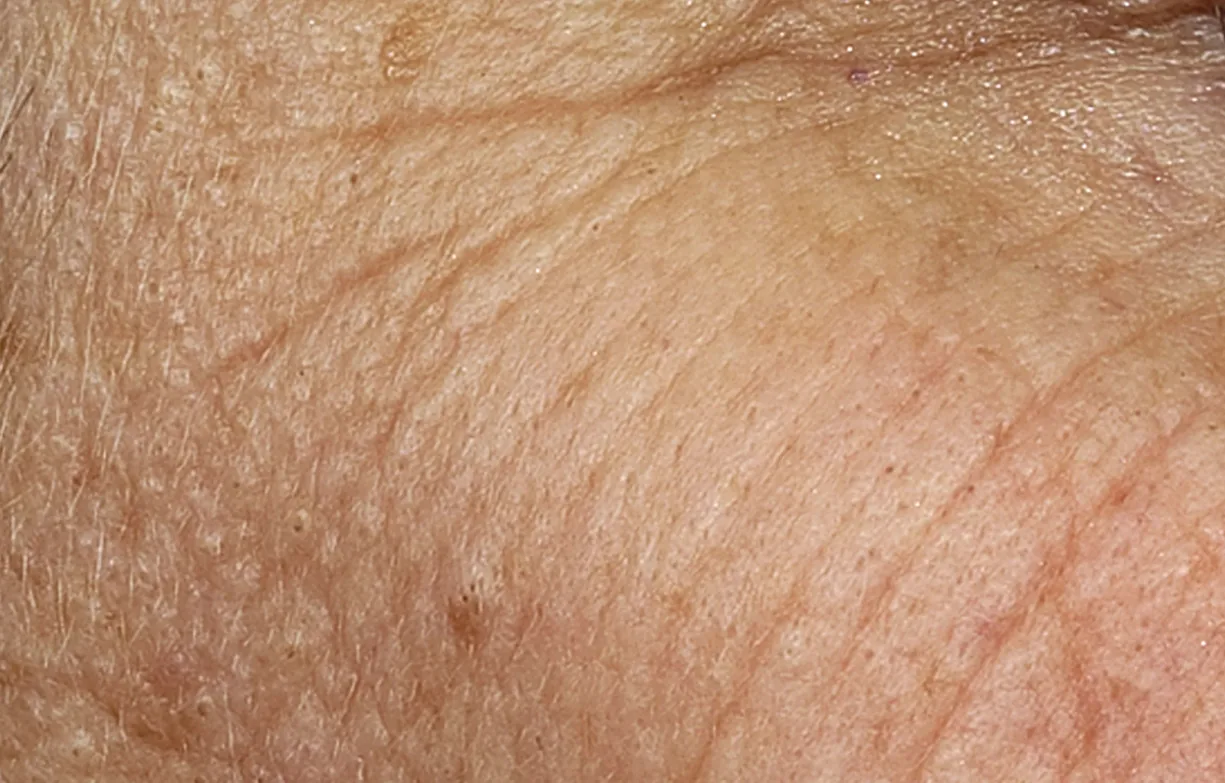 Skin before treatment