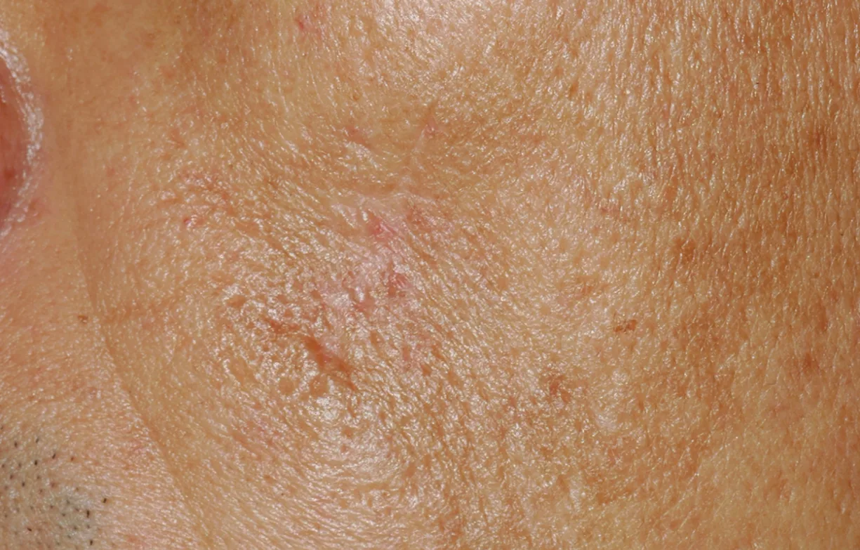 Skin after treatment