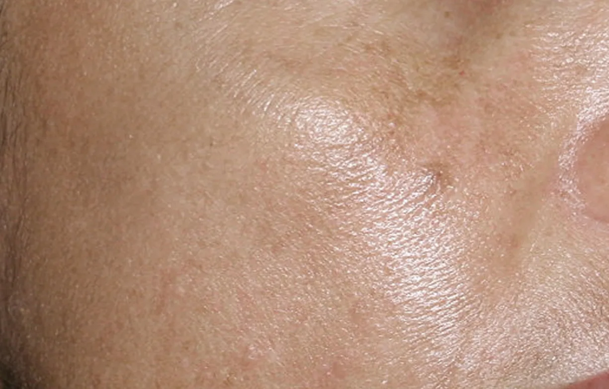 Skin after treatment