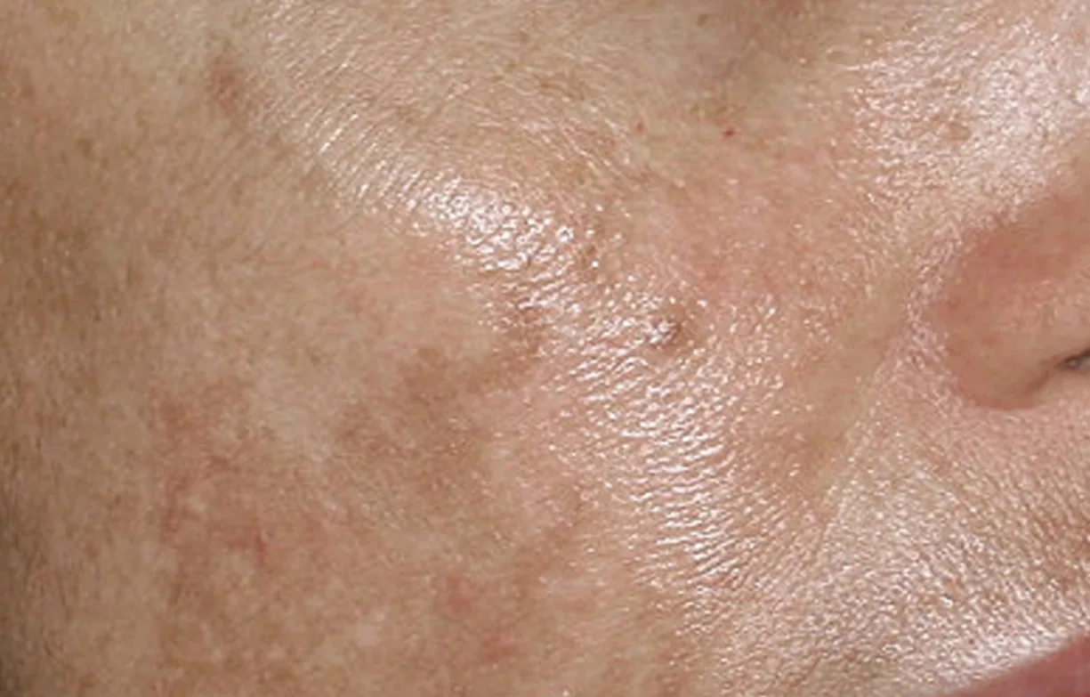 Skin before treatment