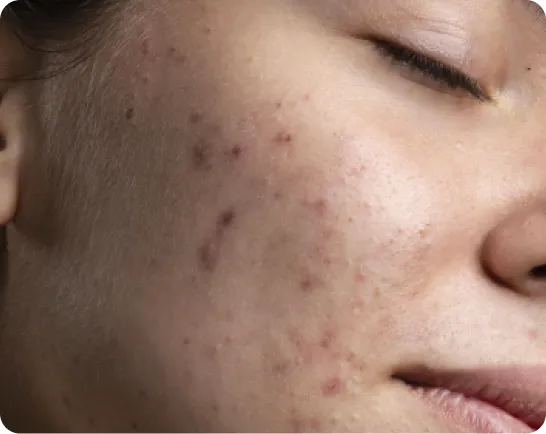 Face with acne scars and enlarged pores