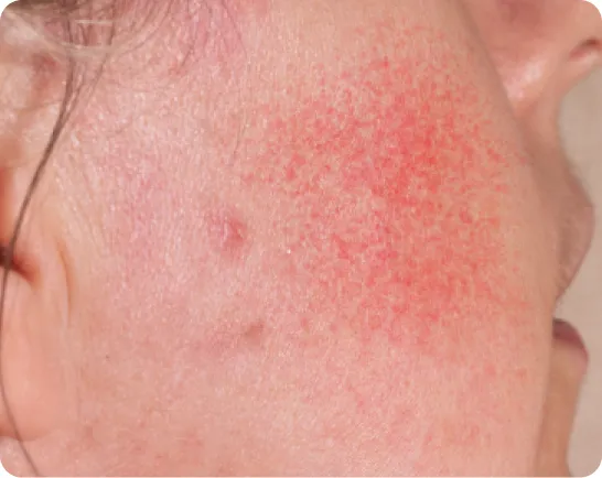 Cheek with red, sun-damaged patches of skin