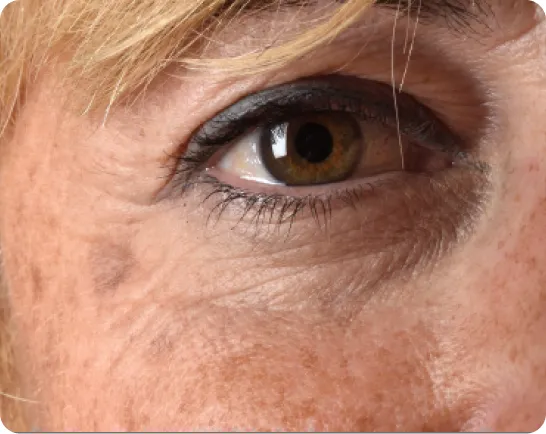 Eye area with sun-damaged, pigmented skin
