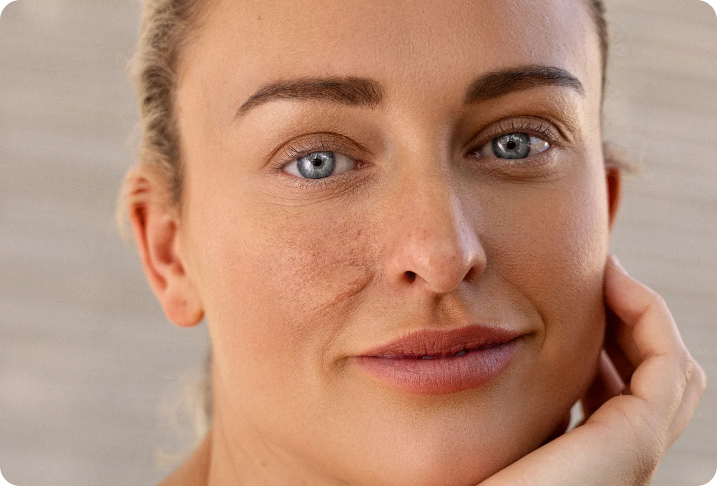 Portrait of Holly with smooth skin after her Fraxel DUAL treatment