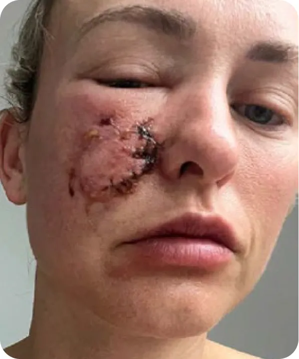 Holly's face with fresh stitches after surgery