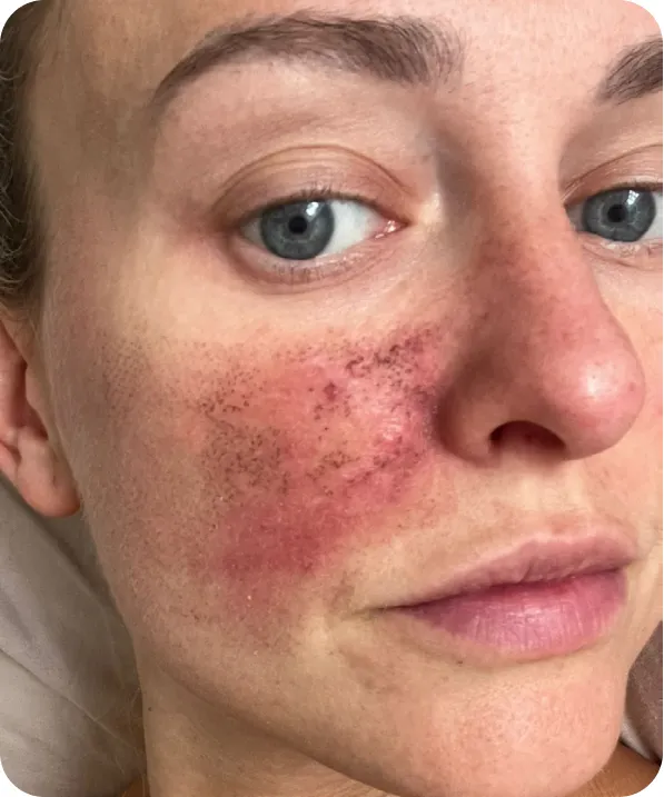 Holly's cheek two days after the first Fraxel DUAL treatment