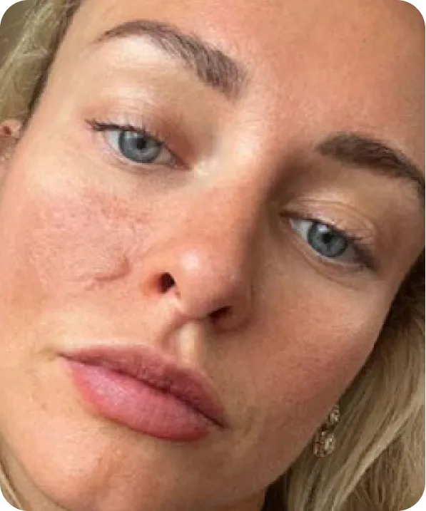 Holly's softened scar after four treatments over 1.5 months